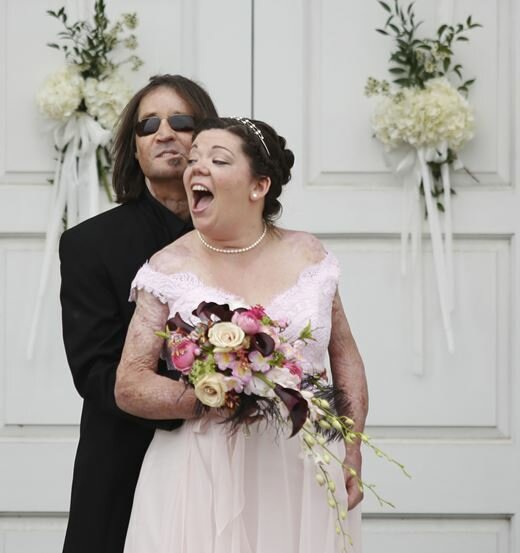 Американцы женились после страшных ожогов. Фотографии