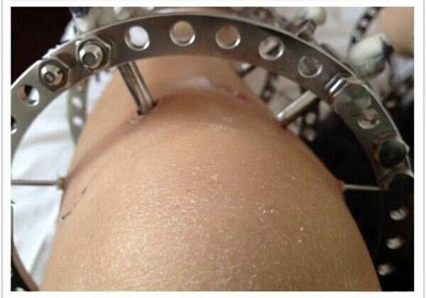 Японская девушка сделала операцию, чтобы удлинить ноги Фотографии